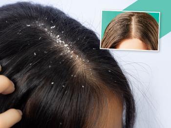 Composition and compound of herbal hair scalp treatment for dandruff